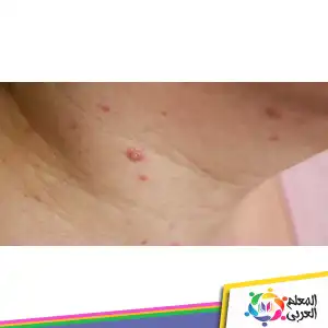 الفرق بين جدري القرود والماء