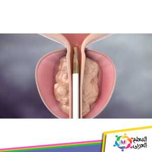 كيفية علاج احتقان البروستاتا بالأعشاب