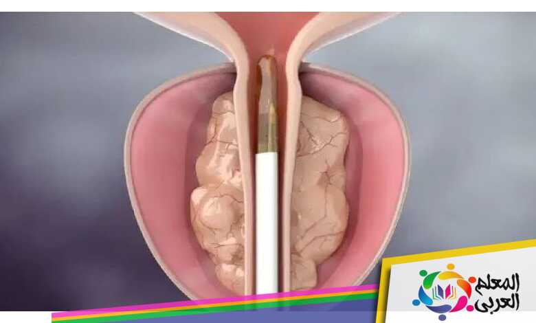 كيفية علاج احتقان البروستاتا بالأعشاب